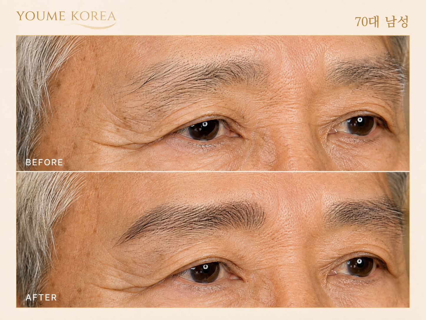 60대 이상 시술 3