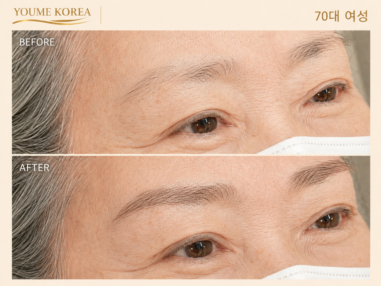 60대 이상 시술 1